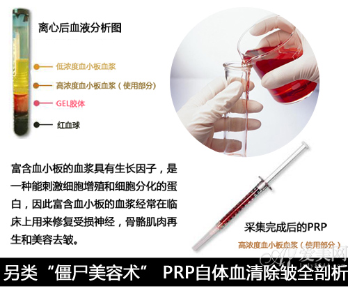 新型医学美容术 PRP自体血清除皱全剖析-收缩